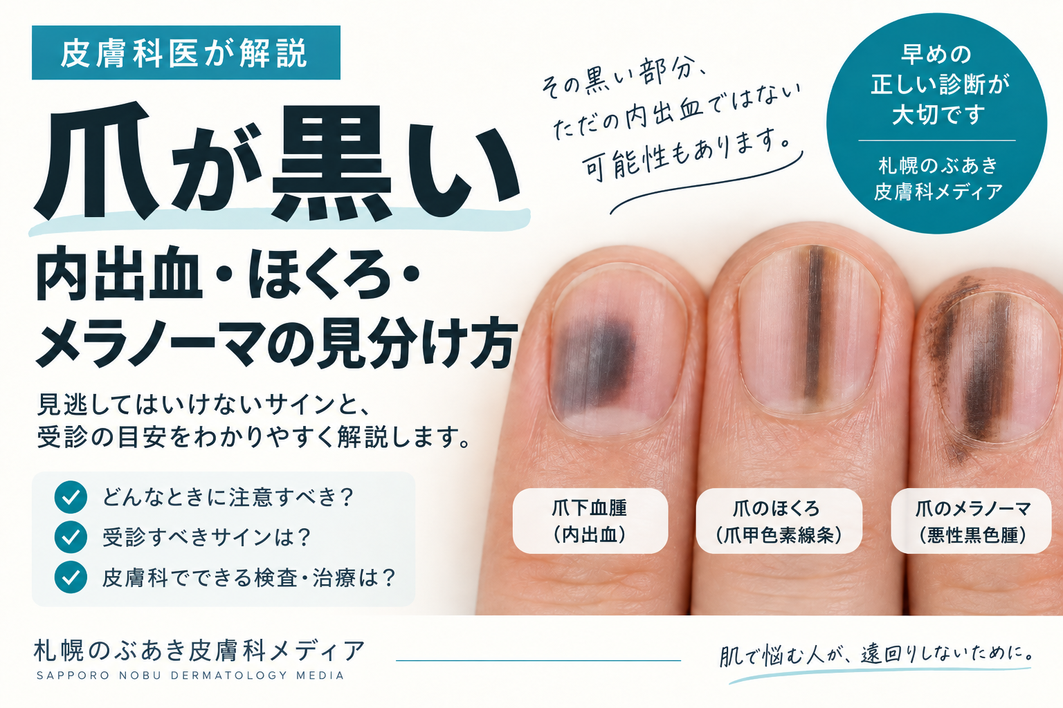 爪が黒いときの内出血・爪のほくろ・爪部メラノーマの違いと、ハッチンソン徴候を示す記事のアイキャッチ画像