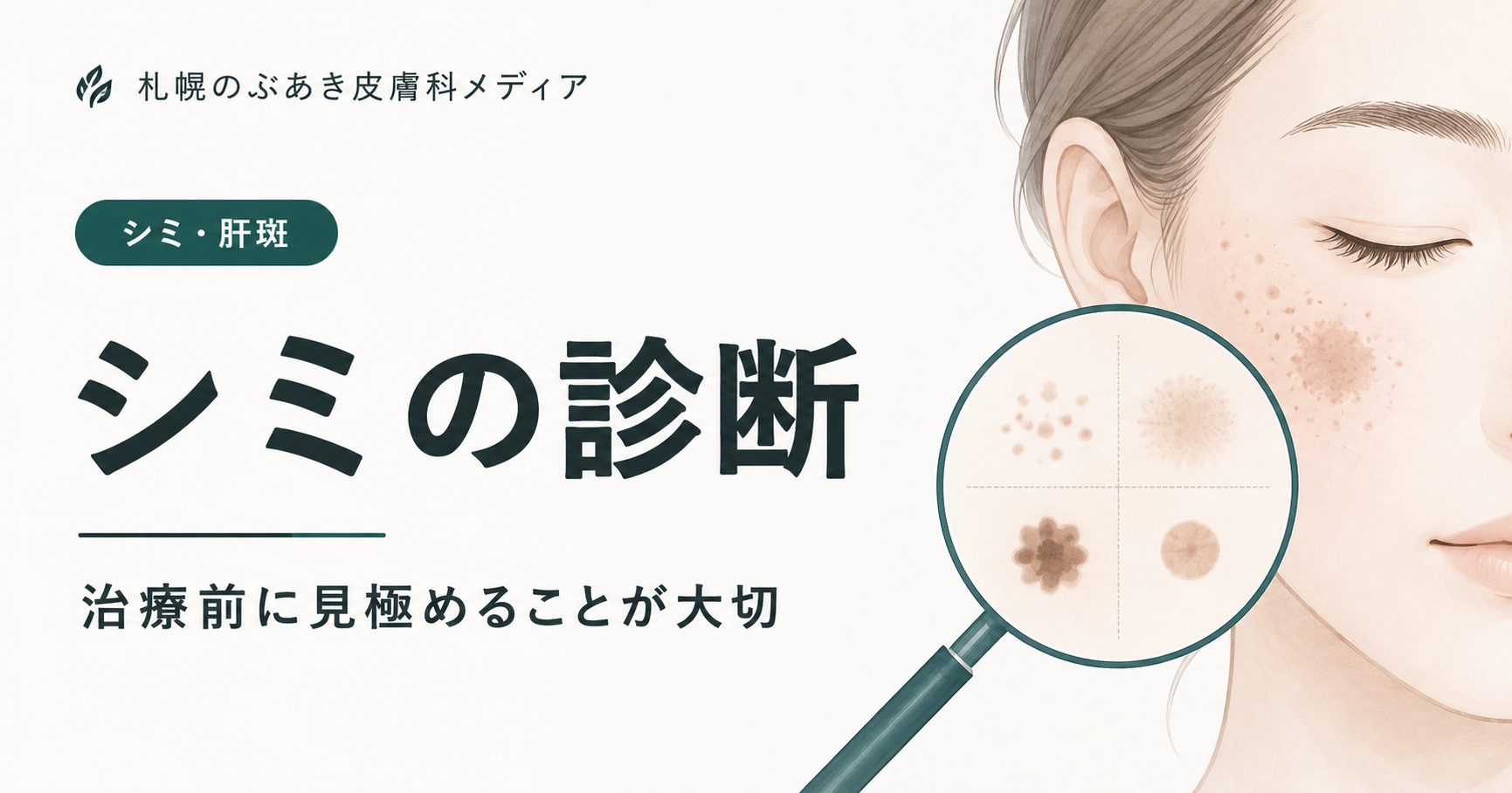 シミの診断｜治療前に見極めることが大切