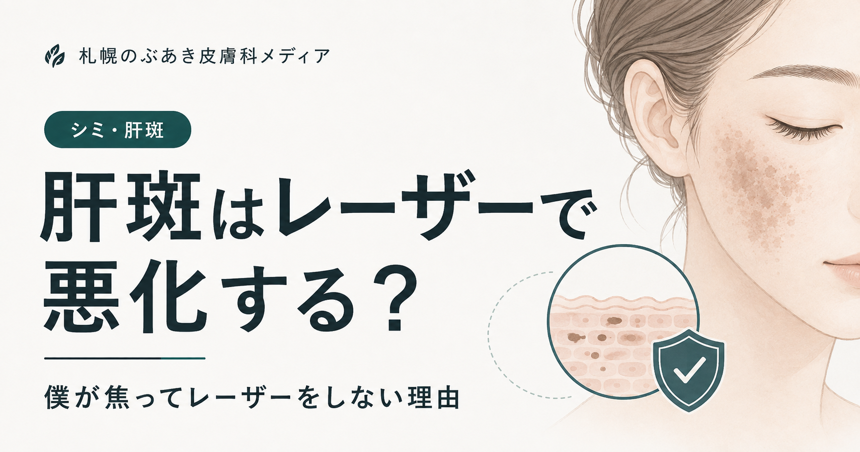 肝斑はレーザーで悪化する?|僕が焦ってレーザーをしない理由