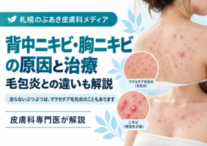 背中ニキビ・胸ニキビとマラセチア毛包炎の違い、原因と治療を解説する記事のアイキャッチ画像