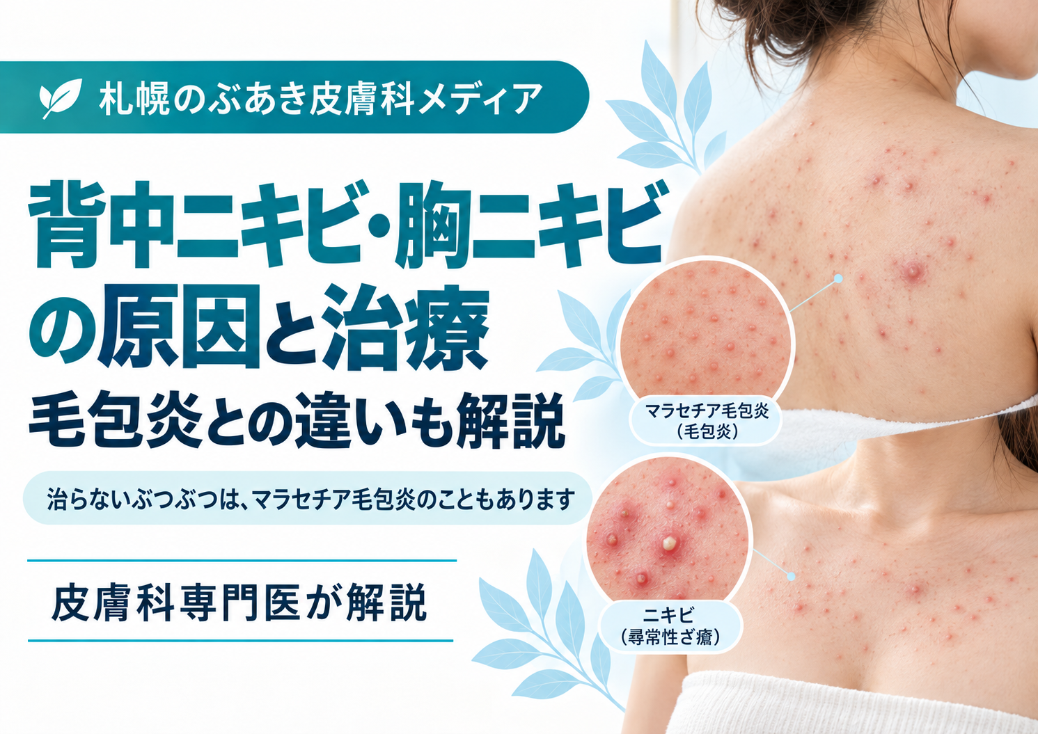 背中ニキビ・胸ニキビとマラセチア毛包炎の違い、原因と治療を解説する記事のアイキャッチ画像