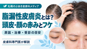 頭皮のフケ・赤み・かゆみと脂漏性皮膚炎を解説するアイキャッチ