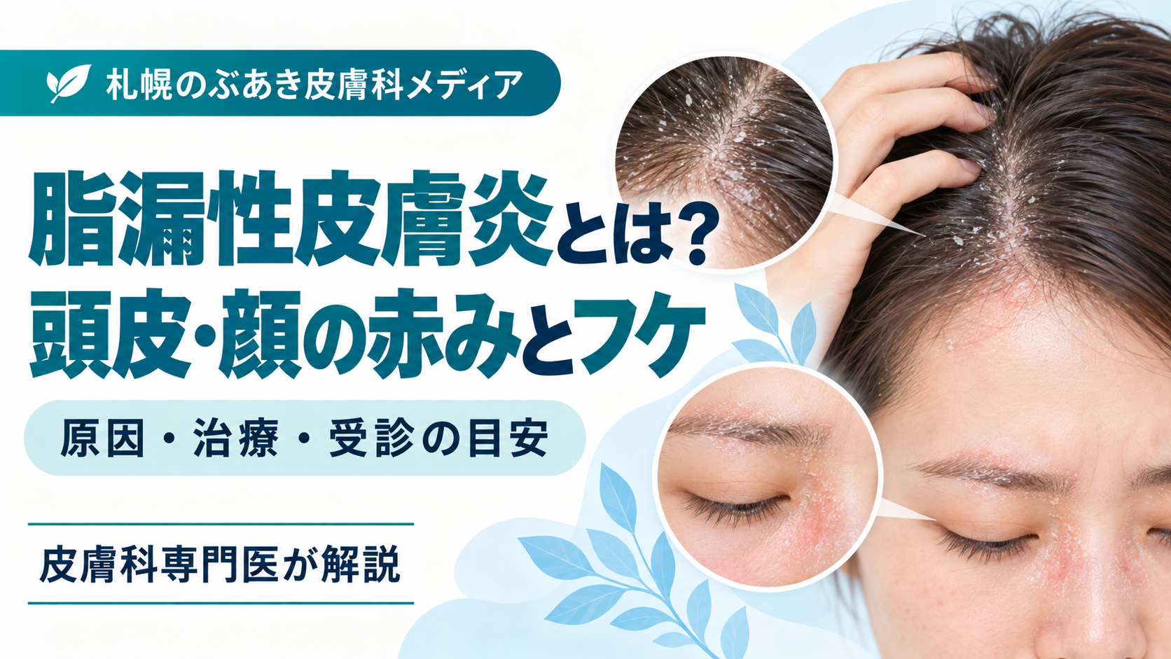頭皮のフケ・赤み・かゆみと脂漏性皮膚炎を解説するアイキャッチ