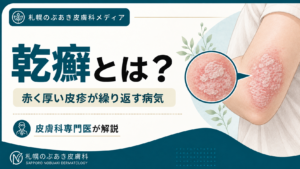 肘の外側に赤く厚い皮疹と銀白色の鱗屑がある乾癬のイラスト