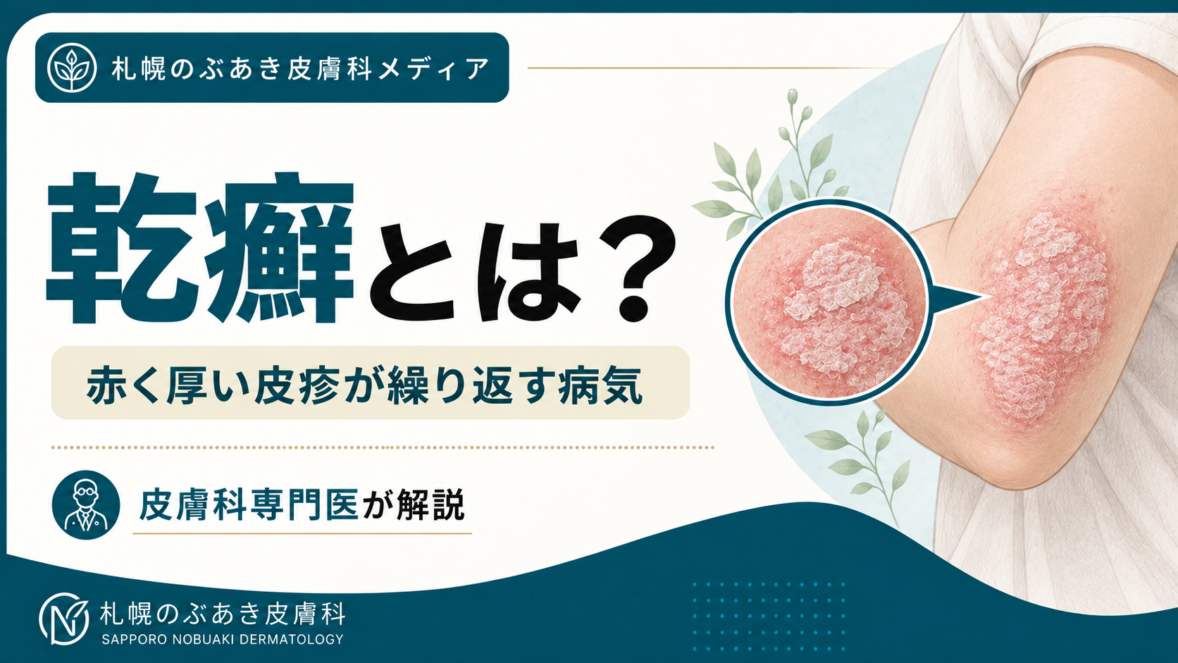 肘の外側に赤く厚い皮疹と銀白色の鱗屑がある乾癬のイラスト