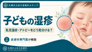 頬に赤みと乾燥のある赤ちゃんと、保護者が肌をケアするイラスト