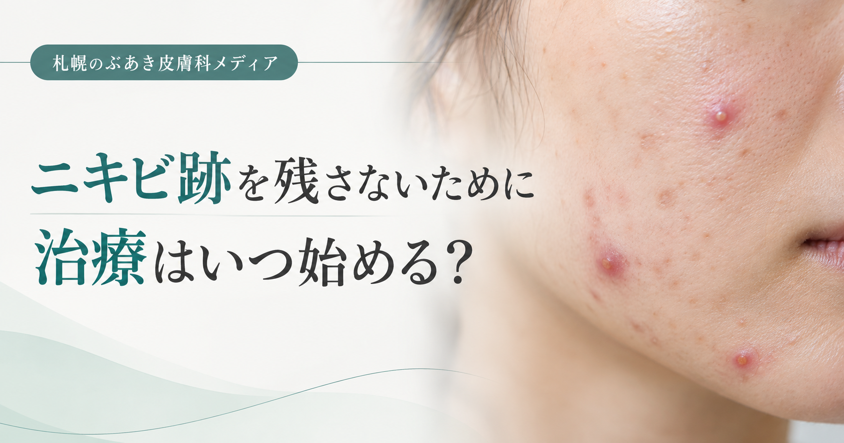 ニキビ跡を残さないために治療を始めるタイミング