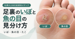 足裏のいぼと魚の目の見分け方