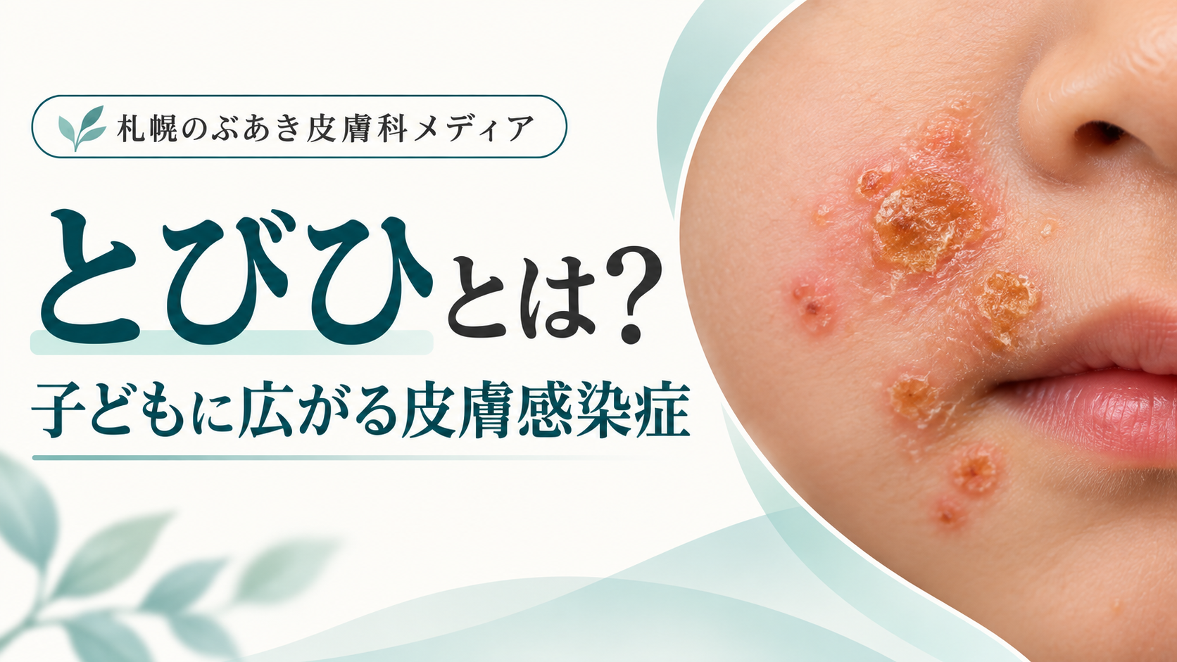 とびひ（伝染性膿痂疹）とは？子どもに広がる皮膚感染症