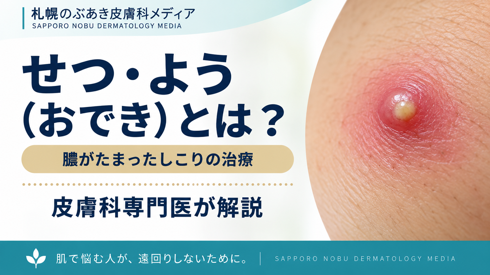 せつ・よう（おでき）とは？膿がたまったしこりの治療