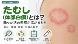 たむし（体部白癬）とは？輪っか状の発疹の症状・原因・診断・治療の目安