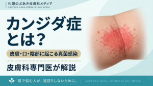 カンジダ症とは？皮膚・口・陰部に起こる真菌感染