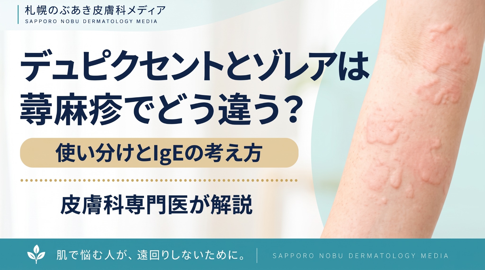 デュピクセントとゾレアは蕁麻疹でどう違う？使い分けとIgEの考え方