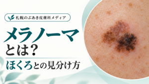メラノーマとは？ほくろとの見分け方