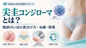 尖圭コンジローマの見分け方・治療・再発を解説するアイキャッチ