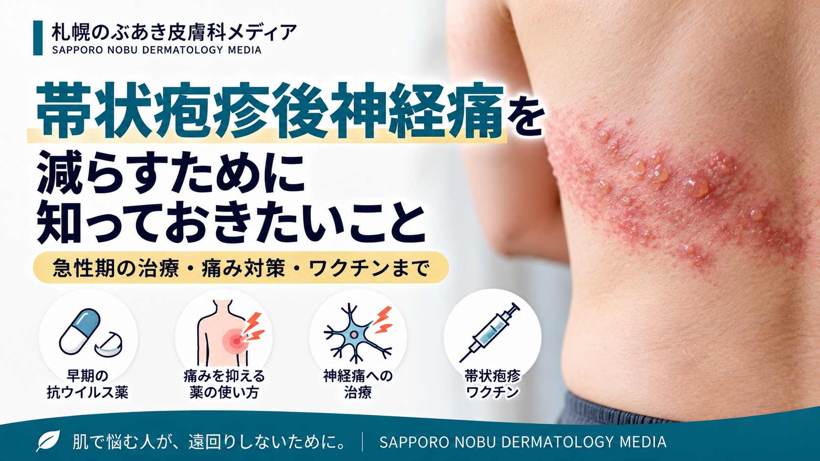 帯状疱疹後神経痛を減らすために知っておきたいこと|急性期の治療と痛み対策