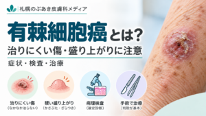 有棘細胞癌とは？治りにくい傷・盛り上がりに注意する皮膚がんの解説