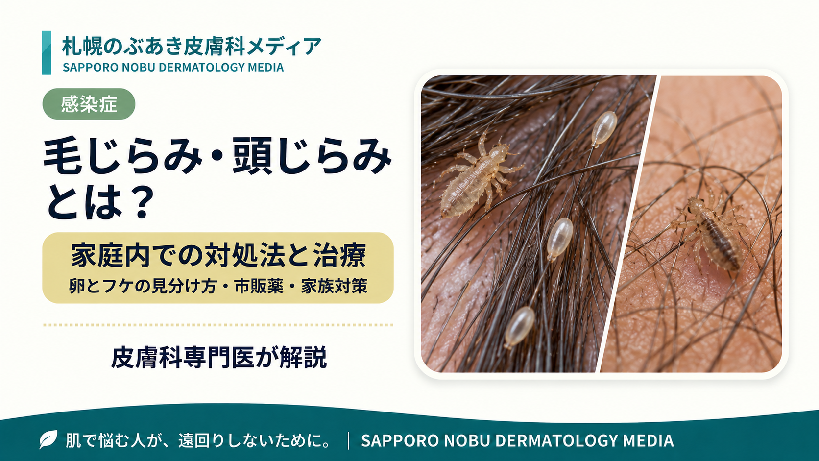 頭じらみと毛じらみの虫体や卵、家庭内での対処法を解説するアイキャッチ画像