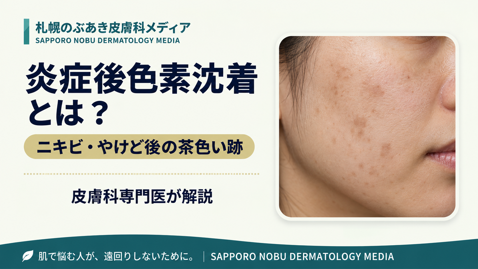 炎症後色素沈着（PIH）の原因とニキビ・やけど後の茶色い跡を解説するアイキャッチ画像