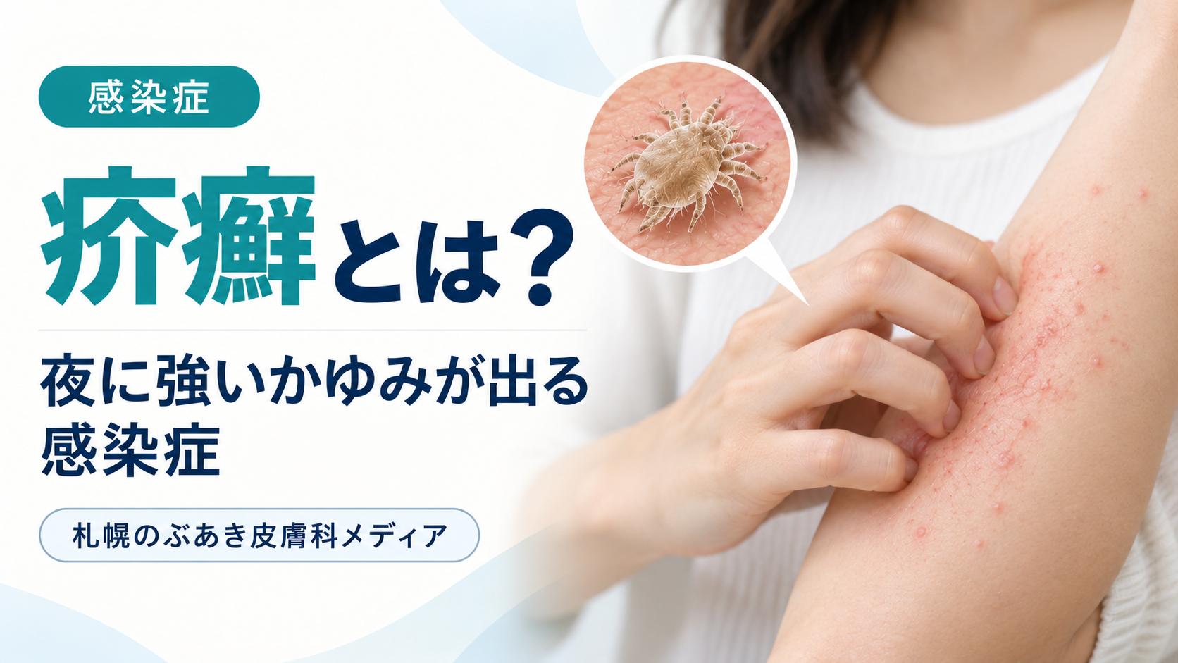 疥癬の症状・検査・治療を解説する記事のアイキャッチ画像