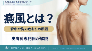 癜風とは？背中や胸の白い・茶色い色むらの原因と治療