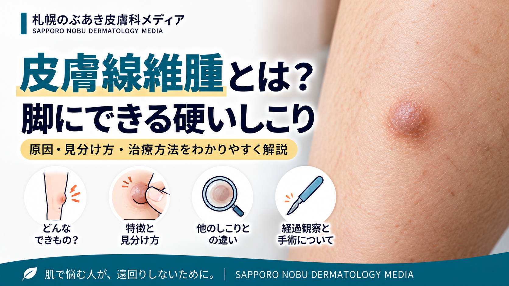 皮膚線維腫とは？脚にできる硬いしこり｜見分け方と治療