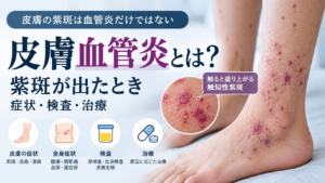 皮膚血管炎による紫斑と触知性紫斑を解説するアイキャッチ画像