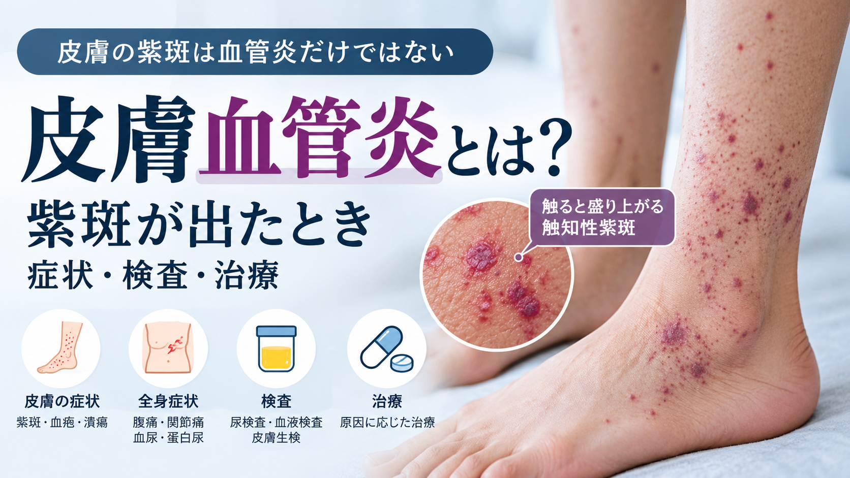 皮膚血管炎による紫斑と触知性紫斑を解説するアイキャッチ画像