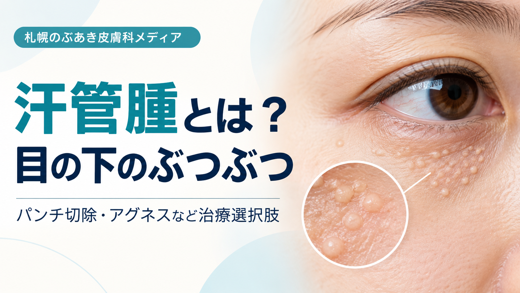 汗管腫の特徴とパンチ切除・アグネスなどの治療選択肢を解説する記事のアイキャッチ画像