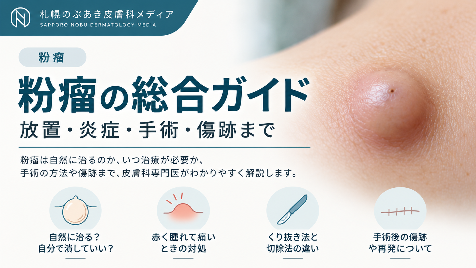 粉瘤の総合ガイド|放置・炎症・手術・傷跡まで