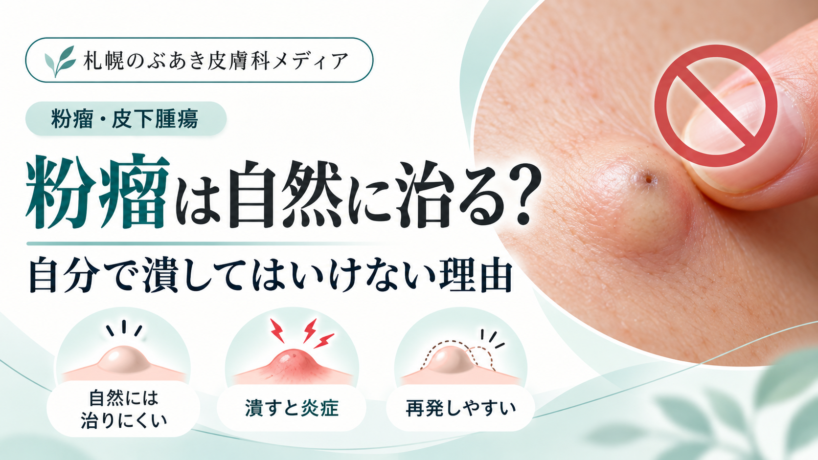粉瘤は自然に治る？自分で潰してはいけない理由