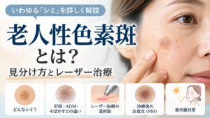老人性色素斑とは？いわゆるシミの見分け方とレーザー治療