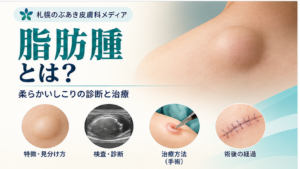 脂肪腫の見分け方・検査・手術を解説するアイキャッチ
