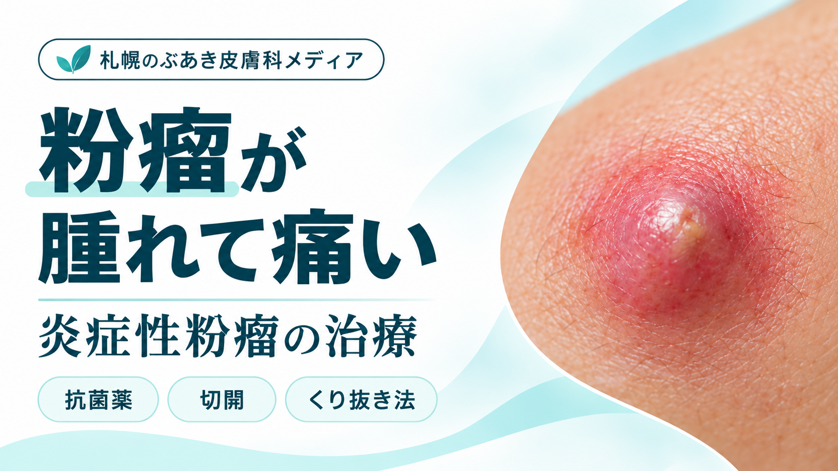 粉瘤が腫れて痛い|炎症性粉瘤の治療・抗菌薬・切開・くり抜き法