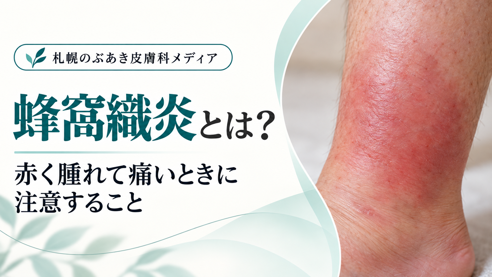 蜂窩織炎とは？赤く腫れて痛いときに注意すること